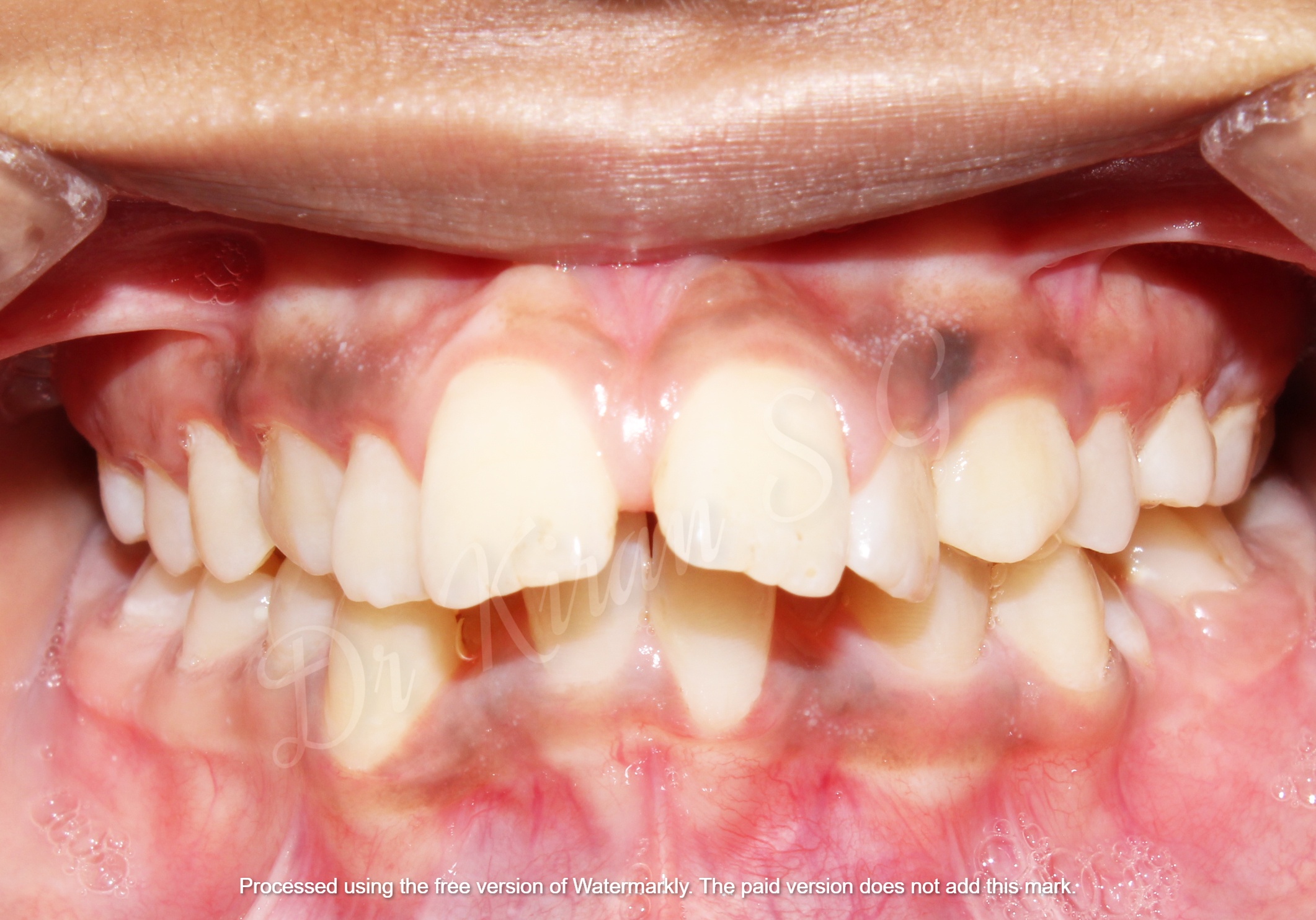 Orthodontic case - front view before treatment