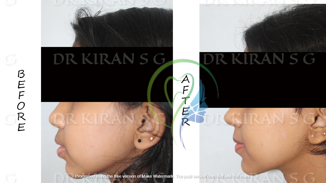 Orthodontic case - profile before and after