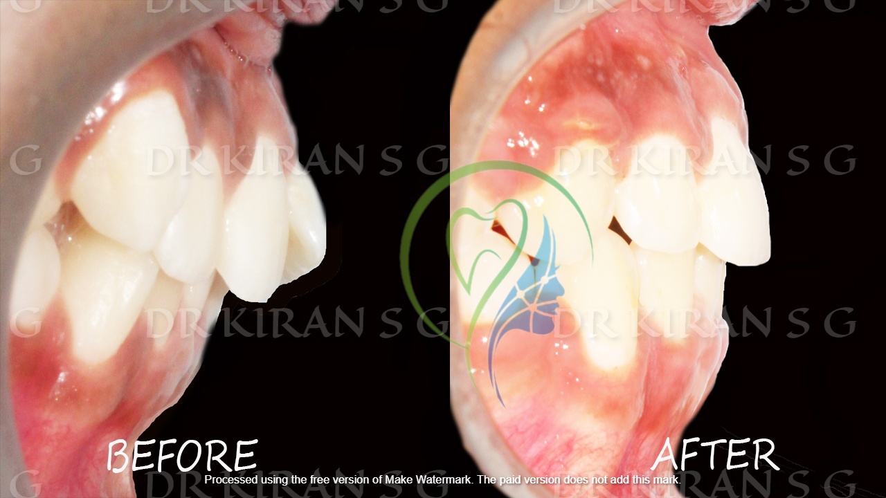 Orthodontic case - side view before and after