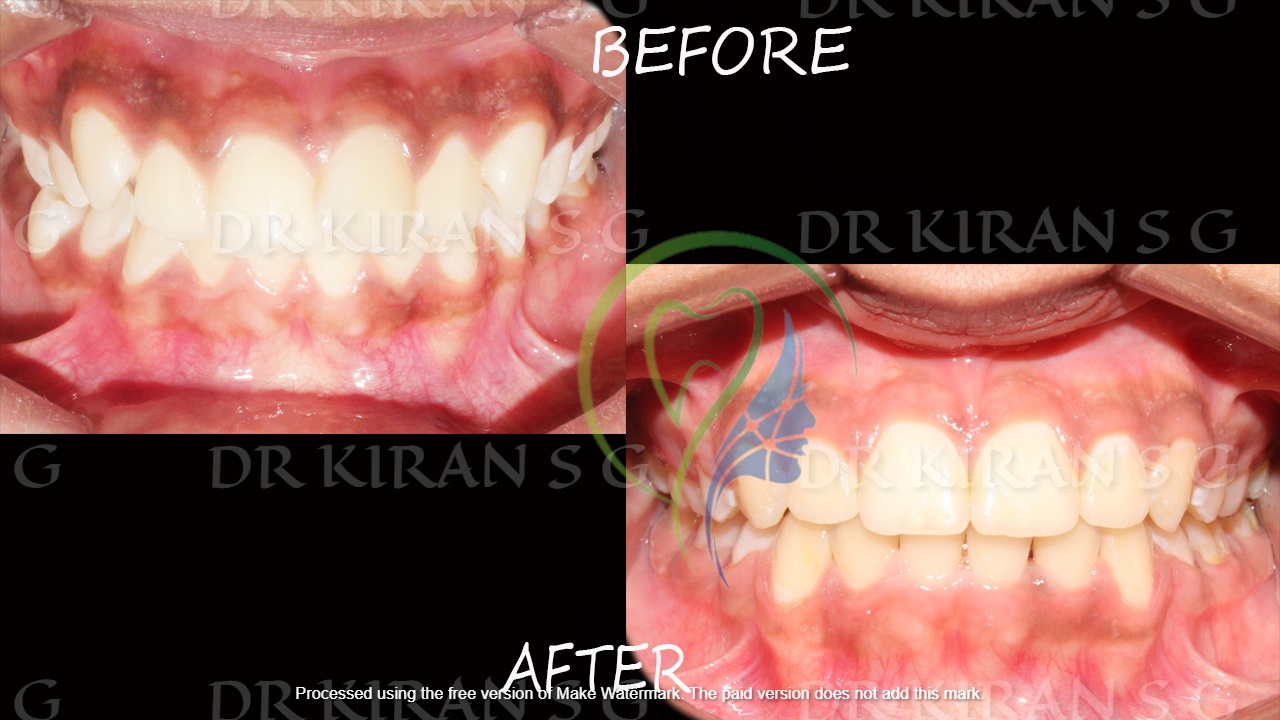 Orthodontic case - front dental before and after