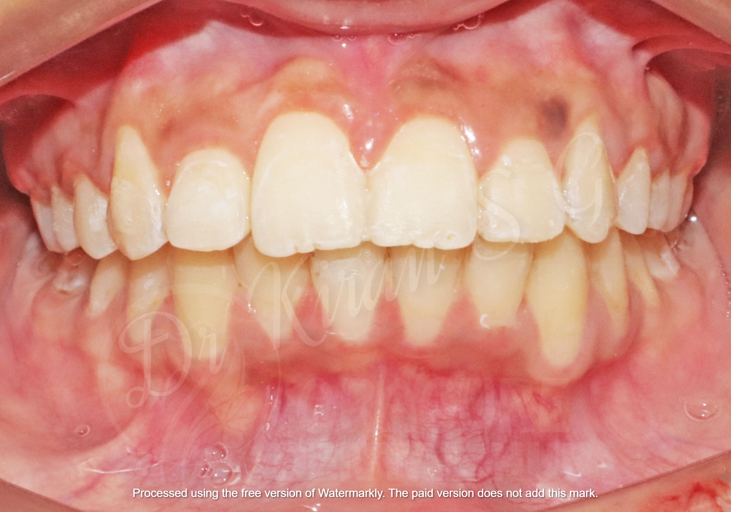 Orthodontic case - front view after treatment